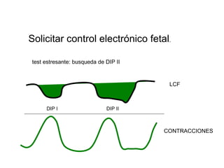 Solicitar control electrónico fetal . test estresante: busqueda de DIP II LCF DIP I DIP II CONTRACCIONES 
