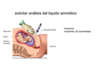 solicitar análisis del liquido amniótico meconio cociente L/E aumentado 
