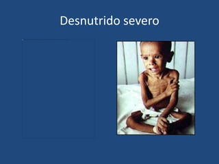 Desnutrido severo
 