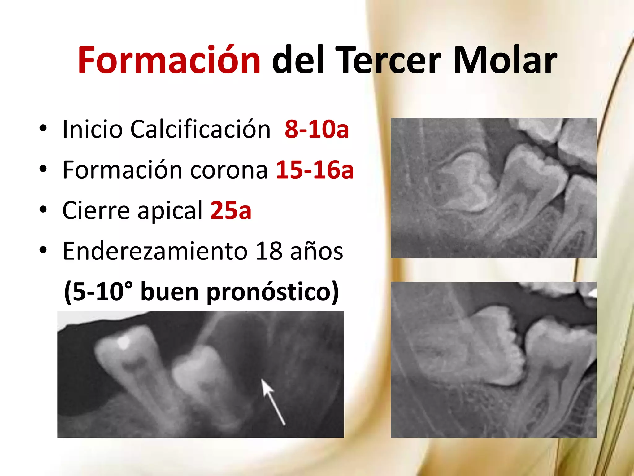 Manejo de los Terceros Molares en Cirugía Maxilofacial | PPTX