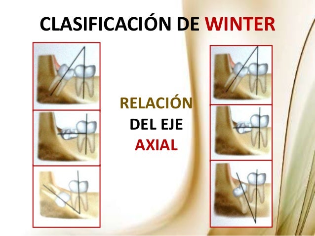 Manejo de los Terceros Molares en Cirugía Maxilofacial