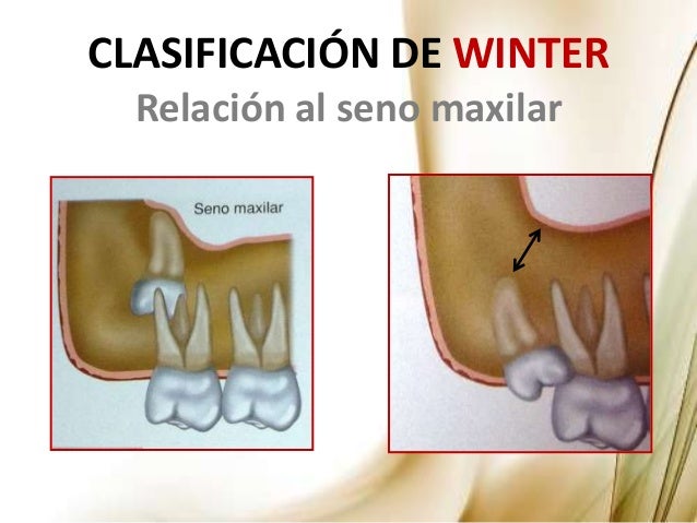 Manejo de los Terceros Molares en Cirugía Maxilofacial