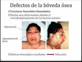 Defectos de la bóveda ósea
0 Fracturas Nasorbito-Etmoidales
0 Mucho mas deformantes debido al
retrodesplazamiento de los huesos nasales
0 Defecto telescópico resultante Telecanto
Deproyección
Aplanamiento del
dorso
 