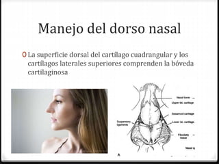 Manejo del dorso nasal
0 La superficie dorsal del cartílago cuadrangular y los
cartílagos laterales superiores comprenden la bóveda
cartilaginosa
 