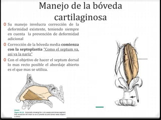 Manejo de la bóveda
cartilaginosa
0 Su manejo involucra corrección de la
deformidad existente, teniendo siempre
en cuenta la prevención de deformidad
adicional
0 Corrección de la bóveda media comienza
con la septoplastia “Como el septum va,
asi va la nariz”
0 Con el objetivo de hacer el septum dorsal
lo mas recto posible el abordaje abierto
es el que mas se utiliza.
 