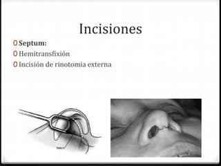 Incisiones
0 Septum:
0 Hemitransfixión
0 Incisión de rinotomia externa
 