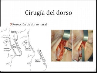 Cirugía del dorso
0 Resección de dorso nasal
0 Resección de giba
 