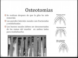 Osteotomias
0 Se realizan despues de que la giba ha sido
removida
0 Las paredes laterales nasales son fracturadas
y medializadas
0 Los huesos nasales deben ser desconectados
de las ramas del maxilar en ambos lados
para medializarlos
 