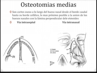 Osteotomias medias
0 Son cortes oseos a lo largo del hueso nasal desde el borde caudal
hasta su borde cefálico, lo mas próximo posible a la union de los
huesos nasales con la lámina perpendicular dele etmoides
0 Via intraseptal Vía intranasal
 