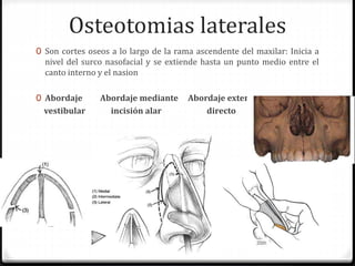 Osteotomias laterales
0 Son cortes oseos a lo largo de la rama ascendente del maxilar: Inicia a
nivel del surco nasofacial y se extiende hasta un punto medio entre el
canto interno y el nasion
0 Abordaje Abordaje mediante Abordaje externo
vestibular incisión alar directo
 