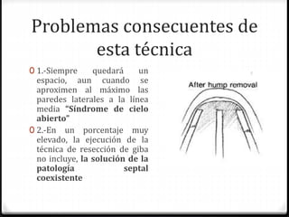 Problemas consecuentes de
esta técnica
0 1.-Siempre quedará un
espacio, aun cuando se
aproximen al máximo las
paredes laterales a la línea
media “Síndrome de cielo
abierto”
0 2.-En un porcentaje muy
elevado, la ejecución de la
técnica de resección de giba
no incluye, la solución de la
patología septal
coexistente
 