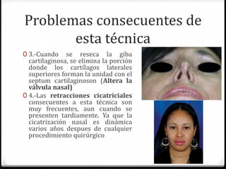 Problemas consecuentes de
esta técnica
0 3.-Cuando se reseca la giba
cartilaginosa, se elimina la porción
donde los cartílagos laterales
superiores forman la unidad con el
septum cartilaginoson (Altera la
válvula nasal)
0 4.-Las retracciones cicatriciales
consecuentes a esta técnica son
muy frecuentes, aun cuando se
presenten tardiamente. Ya que la
cicatrización nasal es dinámica
varios años despues de cualquier
procedimiento quirúrgico
 