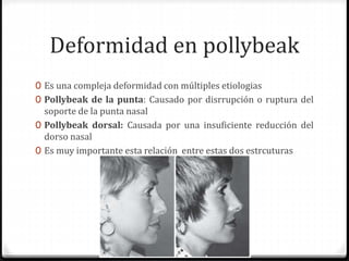 Deformidad en pollybeak
0 Es una compleja deformidad con múltiples etiologias
0 Pollybeak de la punta: Causado por disrrupción o ruptura del
soporte de la punta nasal
0 Pollybeak dorsal: Causada por una insuficiente reducción del
dorso nasal
0 Es muy importante esta relación entre estas dos estrcuturas
 