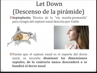 Let Down
(Descenso de la pirámide)
0 Septoplastia Técnica de la “vía maxila-premaxila”
para cirugía del septum nasal descrita por Cottle
0 Puesto que el septum nasal es el soporte del dorso
nasal, se necesita disminuir las dimensiones
septales, de lo contrario nunca descenderá o se
hundirá el dorso nasal
 