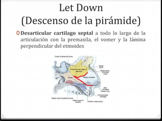Let Down
(Descenso de la pirámide)
0 Desarticular cartilago septal a todo lo largo de la
articulación con la premaxila, el vomer y la lámina
perpendicular del etmoides
 
