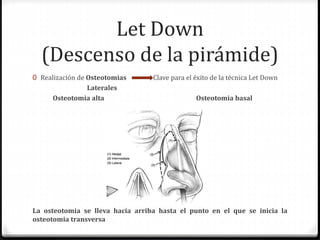 Let Down
(Descenso de la pirámide)
0 Realización de Osteotomias Clave para el éxito de la técnica Let Down
Laterales
Osteotomia alta Osteotomia basal
La osteotomia se lleva hacia arriba hasta el punto en el que se inicia la
osteotomia transversa
 