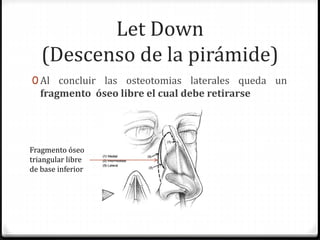 Let Down
(Descenso de la pirámide)
0 Al concluir las osteotomias laterales queda un
fragmento óseo libre el cual debe retirarse
Fragmento óseo
triangular libre
de base inferior
 