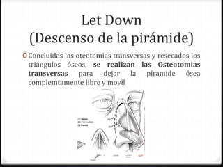 Let Down
(Descenso de la pirámide)
0 Concluidas las oteotomias transversas y resecados los
triángulos óseos, se realizan las Osteotomias
transversas para dejar la píramide ósea
complemtamente libre y movil
 