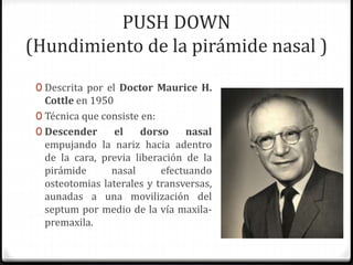 PUSH DOWN
(Hundimiento de la pirámide nasal )
0 Descrita por el Doctor Maurice H.
Cottle en 1950
0 Técnica que consiste en:
0 Descender el dorso nasal
empujando la nariz hacia adentro
de la cara, previa liberación de la
pirámide nasal efectuando
osteotomias laterales y transversas,
aunadas a una movilización del
septum por medio de la vía maxila-
premaxila.
 