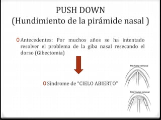 PUSH DOWN
(Hundimiento de la pirámide nasal )
0 Antecedentes: Por muchos años se ha intentado
resolver el problema de la giba nasal resecando el
dorso (Gibectomia)
0 Síndrome de “CIELO ABIERTO”
 