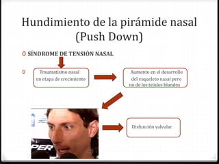 Hundimiento de la pirámide nasal
(Push Down)
0 SÍNDROME DE TENSIÓN NASAL
0 Traumatismo nasal Aumento en el desarrollo
en etapa de crecimiento del esqueleto nasal pero
no de los tejidos blandos
Disfunción valvular
 