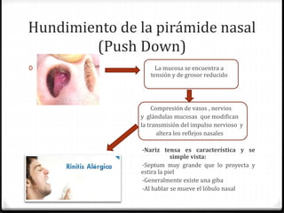 Hundimiento de la pirámide nasal
(Push Down)
0 La mucosa se encuentra a
tensión y de grosor reducido
Compresión de vasos , nervios
y glándulas mucosas que modifican
la transmisión del impulso nervioso y
altera los reflejos nasales
-Nariz tensa es característica y se
detecta a simple vista:
-Septum muy grande que lo proyecta y
estira la piel
-Generalmente existe una giba
-Al hablar se mueve el lóbulo nasal
 
