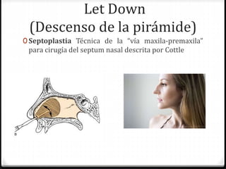 Let Down
(Descenso de la pirámide)
0 Septoplastia Técnica de la “vía maxila-premaxila”
para cirugía del septum nasal descrita por Cottle
 