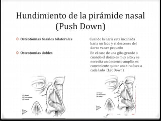 Hundimiento de la pirámide nasal
(Push Down)
0 Osteotomias basales bilaterales Cuando la nariz esta inclinada
hacia un lado y el descenso del
dorso va ser pequeño
0 Osteotomias dobles En el caso de una giba grande o
cuando el dorso es muy alto y se
necesita un descenso amplio, es
conveniente quitar una tira ósea a
cada lado (Let Down)
 