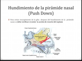 Hundimiento de la pirámide nasal
(Push Down)
0 Para evitar resurgimiento de la giba despues del hundimiento de la pirámide
nasal, se debe verificar si existe la acción de resorte del septum
 