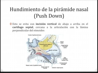 Hundimiento de la pirámide nasal
(Push Down)
0 Esto se evita con incisión vertical de abajo a arriba en el
cartílago septal, cercana a la articulación con la lámina
perpendicular del etmoides
 