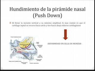 Hundimiento de la pirámide nasal
(Push Down)
0 Al llevar la incisión vertical a su máxima amplitud, lo mas común es que el
cartílago septal se recorra hacia atrás y tire hacia abajo eldorso cartilaginoso
0 DEFORMIDAD EN SILLA DE MONTAR
 