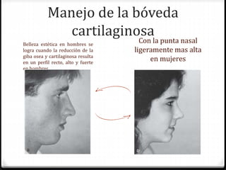 Manejo de la bóveda
cartilaginosa
Belleza estética en hombres se
logra cuando la reducción de la
giba osea y cartilaginosa resulta
en un perfil recto, alto y fuerte
en hombres
Con la punta nasal
ligeramente mas alta
en mujeres
 