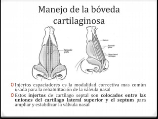 Manejo de la bóveda
cartilaginosa
0 Injertos espaciadores es la modalidad correctiva mas común
usada para la rehabilitación de la válvula nasal
0 Estos injertos de cartílago septal son colocados entre las
uniones del cartílago lateral superior y el septum para
ampliar y estabilizar la válvula nasal
 