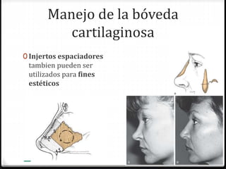 Manejo de la bóveda
cartilaginosa
0 Injertos espaciadores
tambien pueden ser
utilizados para fines
estéticos
 