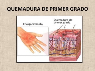 QUEMADURA DE PRIMER GRADO




                        10
 
