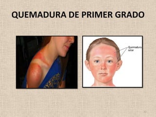 QUEMADURA DE PRIMER GRADO




                        11
 