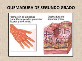 QUEMADURA DE SEGUNDO GRADO




                             13
 