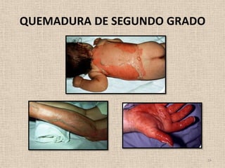 QUEMADURA DE SEGUNDO GRADO




                             14
 