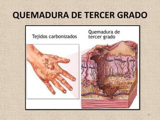 QUEMADURA DE TERCER GRADO




                            16
 