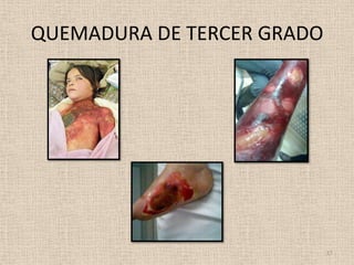 QUEMADURA DE TERCER GRADO




                            17
 