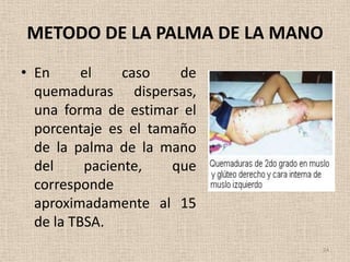 METODO DE LA PALMA DE LA MANO
• En      el    caso   de
  quemaduras dispersas,
  una forma de estimar el
  porcentaje es el tamaño
  de la palma de la mano
  del     paciente,   que
  corresponde
  aproximadamente al 15
  de la TBSA.
                            24
 