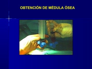 OBTENCIÓN DE MÉDULA ÓSEA
 