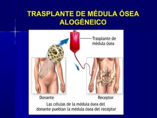 TRASPLANTE DE MÉDULA ÓSEA
ALOGÉNEICO
 