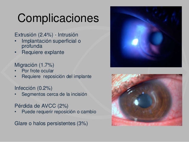 Ojos Anillos Intraestromales Anillos Corneales Anillos Corneales