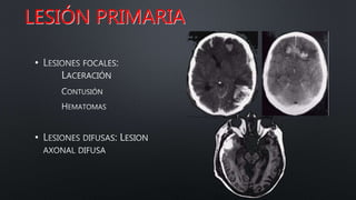 LESIÓN PRIMARIA
•
•
 