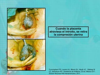 Cuando la placenta
atraviesa el introito, se retira
la compresión uterina
Cunningham FG, Leveno KJ, Bloom SL, Hauth JC, Gilstrap III
LC, Wenstrom KD. Obstetricia de Williams. 23 ed. México D.F.:
Edición McGraw-Hill Interamericana; 2011.
 