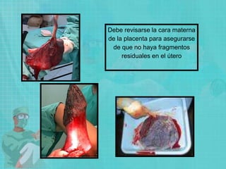 Debe revisarse la cara materna
de la placenta para asegurarse
de que no haya fragmentos
residuales en el útero
 