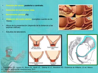• Posición del cérvix: posterior o centrado.
• Detección de membranas rotas.
• Borramiento cervical (%)
• Dilatación del cuello uterino (completa cuando es de
10cm).
• Altura de la presentación (depende de la distancia a las
espinas ciáticas).
• Estudios de laboratorio.
1. Cunningham FG, Leveno KJ, Bloom SL, Hauth JC, Gilstrap III LC, Wenstrom KD. Obstetricia de Williams. 23 ed. México
D.F.: Edición McGraw-Hill Interamericana; 2011.
2. http://f.tqn.com/y/pregnancy/1/S/E/e/3/Fotosearch_COG12024.jpg
 