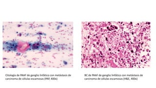 BC de PAAF de ganglio linfático con metástasis de
carcinoma de células escamosas (H&E, 400x)
Citología de PAAF de ganglio linfático con metástasis de
carcinoma de células escamosas (PAP, 400x)
 