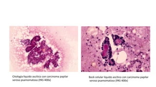 Citología líquido ascítico con carcinoma papilar
seroso psamomatoso (PAS 400x)
Bock celular líquido ascítico con carcinoma papilar
seroso psamomatoso (PAS 400x)
 
